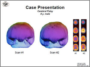 case presentation hbot chronic brain injury