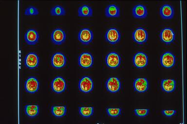 hbot spect imaging brain