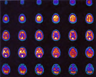 HBOT SPECT Figure 41-3a
