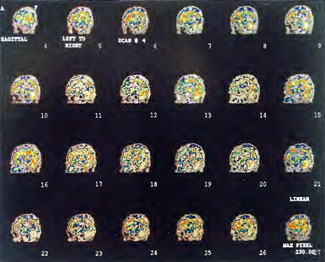 HBOT SPECT Figure 41-5e