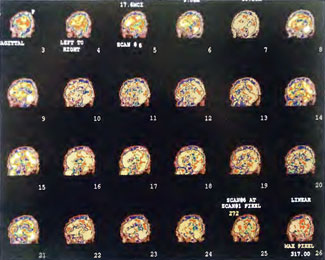 HBOT SPECT Figure 41-5h