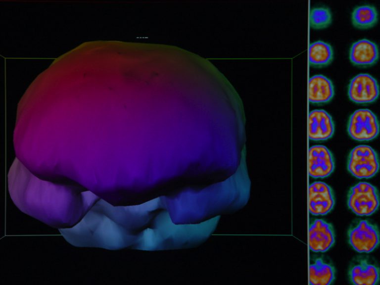 SPECT Imaging Harch Hyperbaric Oxygen Therapy