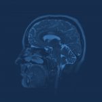 MRI brain scan HBOT