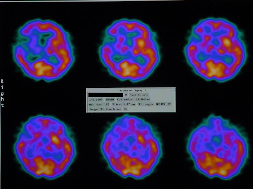 SPECT brain blood flow scan