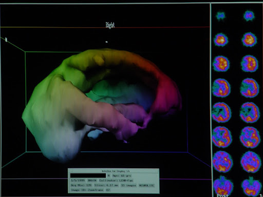 SPECT brain blood flow scan 2